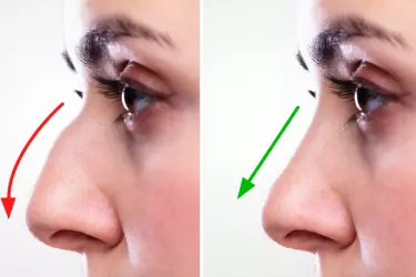 best hospital for nose correction surgery in Gurgaon, best doctor for rhinoplasty surgery in Gurgaon, cost of nose correction surgery in Gurgaon